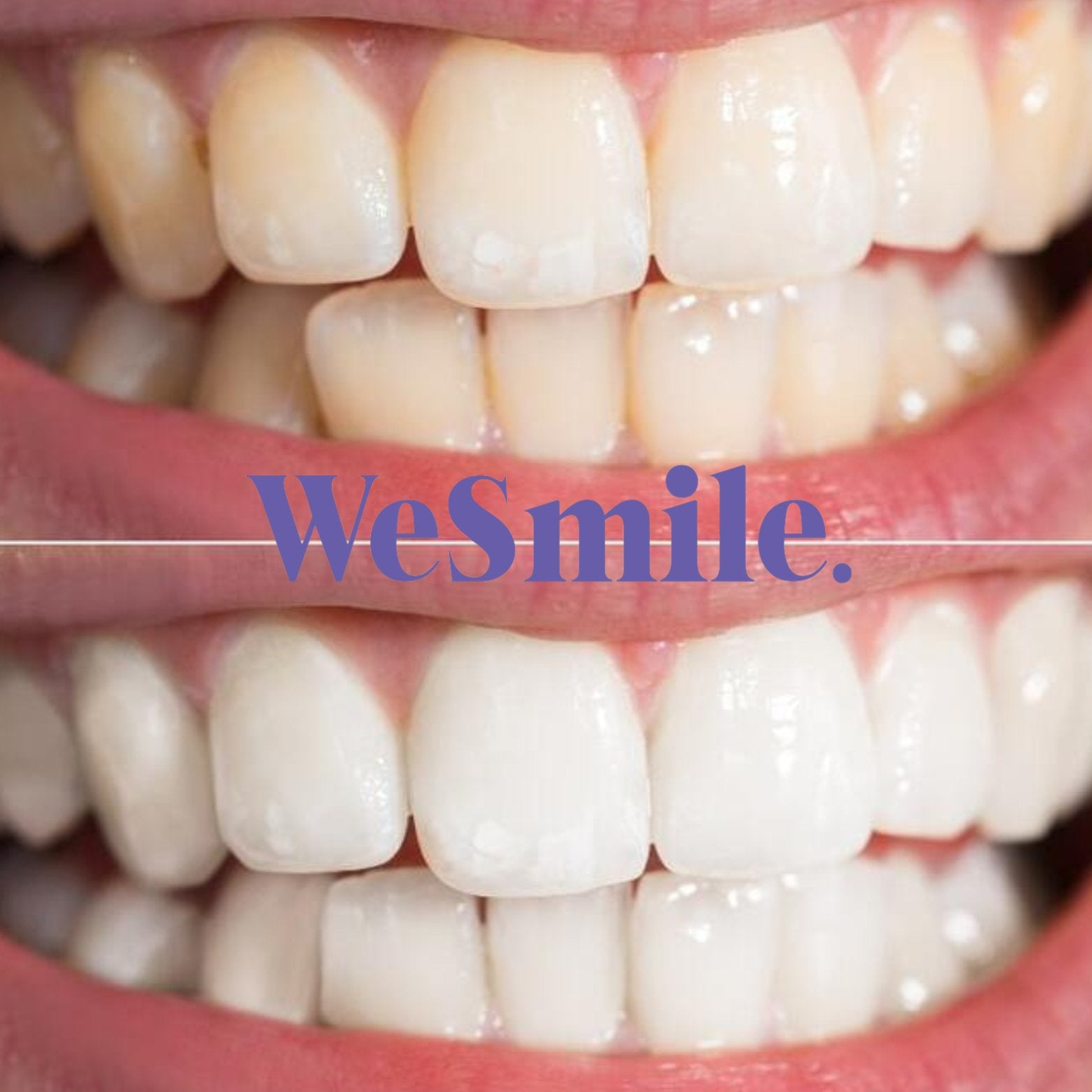Kit de Blanchiment dentaire LED - WeSmile